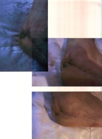 Osteomilitis Patient 49 J